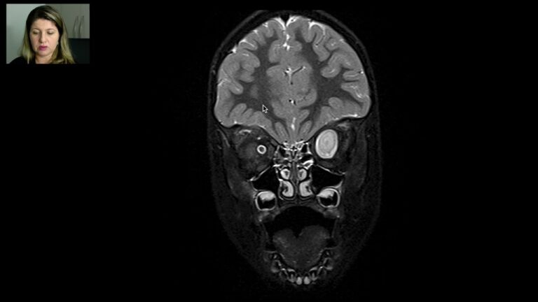 Anatomia e Função do Nervo Óptico Normal