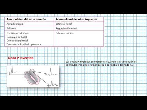 Onda P Invertida: Entendendo suas Implicações Clínicas