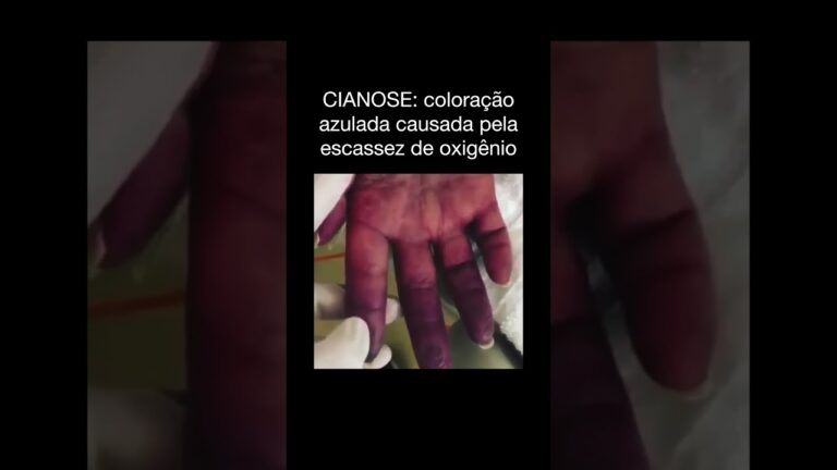 Causas da Cianose nas Extremidades