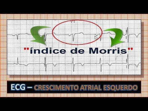 Entendendo o Índice de Morris: Uma Ferramenta de Avaliação de Risco