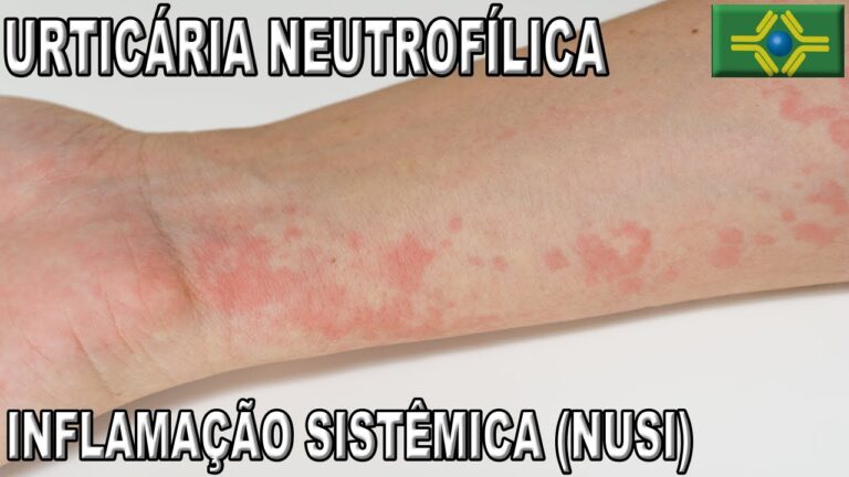 Dermatose Neutrofílica: Causas, Sintomas e Tratamentos Eficazes