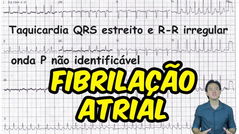 Entendendo a Fibrilação Atrial Eletro: Causas e Tratamentos