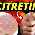 Entenda sobre veia grossa na perna