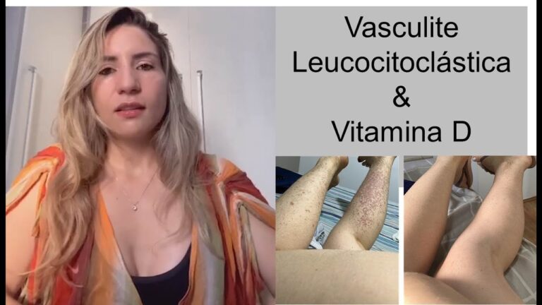 Vasculite Leucocitoclástica: Entendendo A Condição Através de Fotos