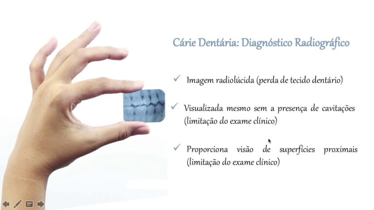 Detec&ccedil;&atilde;o de C&aacute;rie na Radiografia: T&eacute;cnicas e Interpreta&ccedil;&otilde;es
