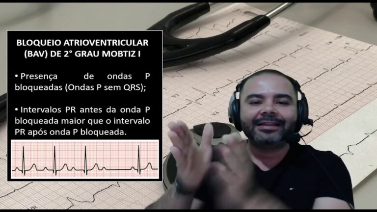 BAV 2 Grau Mobitz 1: Entendendo o Diagnóstico e Tratamento