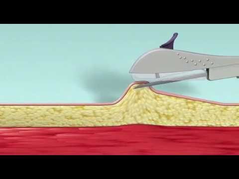 Guia Completo sobre a Agulha do Implanon