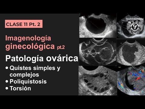 Causas e Implicações dos Ovarios Aumentados
