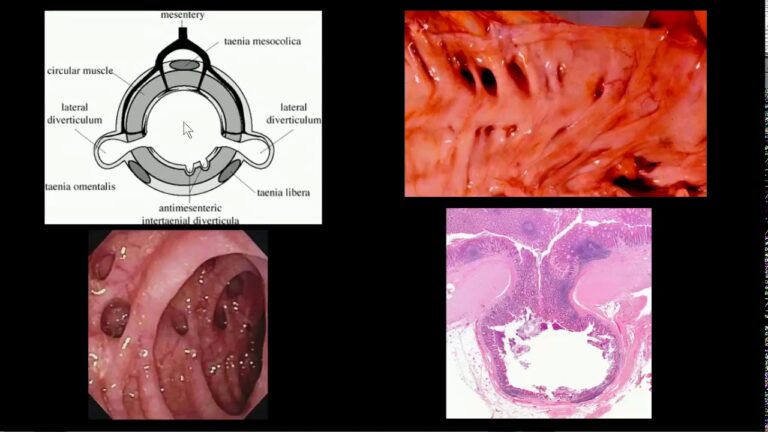Entendendo as Doenças Diverticulares do Cólon