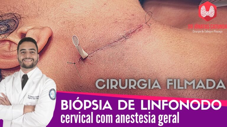 Preço da Cirurgia de Retirada de Linfonodo no Pescoço