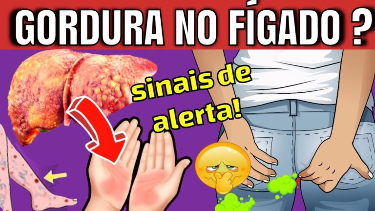 Sintomas do Fígado Gorduroso Grau 4: O Que Você Precisa Saber