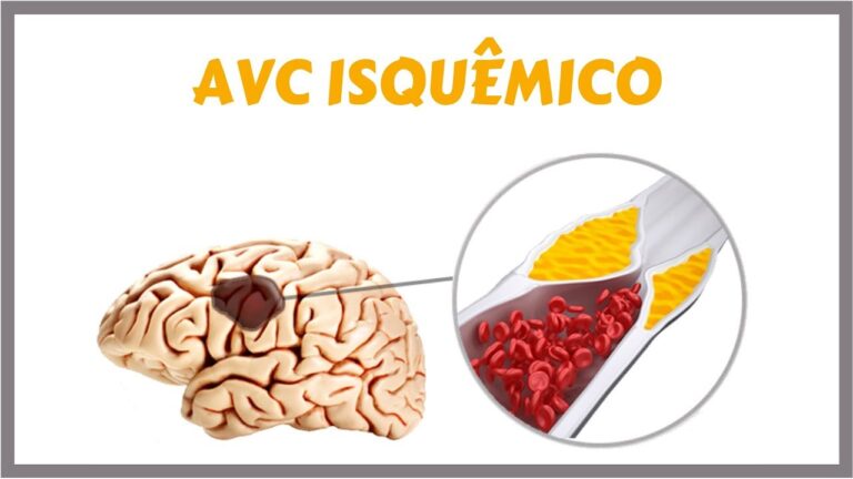 Entendendo o AVCI: O Que &Eacute; e Como Reconhecer