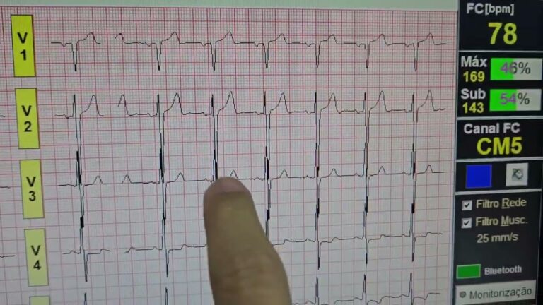 Alteração da Repolarização Ventricular Inferior: Causas e Implicações Clínicas
