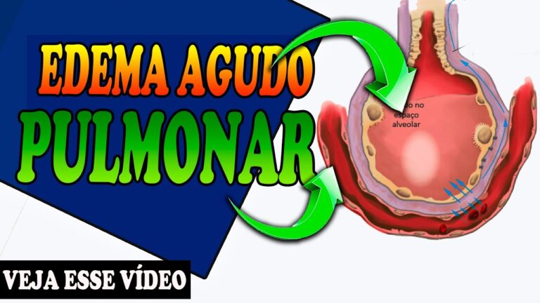Fisiopatologia do Edema Agudo de Pulmão