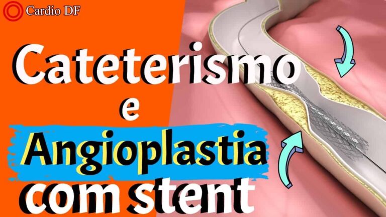 Sintomas da Rejeição de Stent: O Que Observar?
