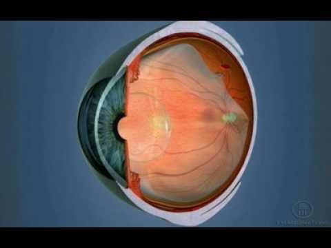 Furo na Retina: Possibilidades de Cura e Tratamento