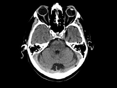 Entendendo as Placas Ateromatosas Calcificadas e Seus Efeitos na Saúde Cardiovascular