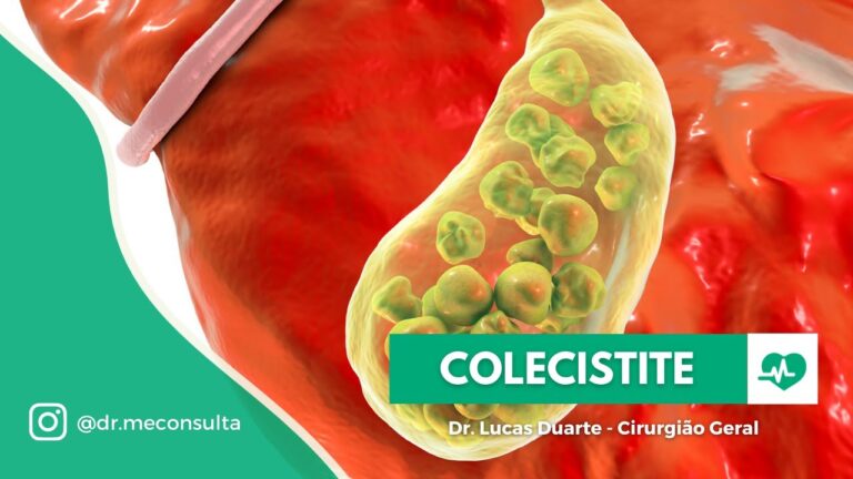 Colecistopatia Calculosa: Entenda os Riscos e Complicações ...