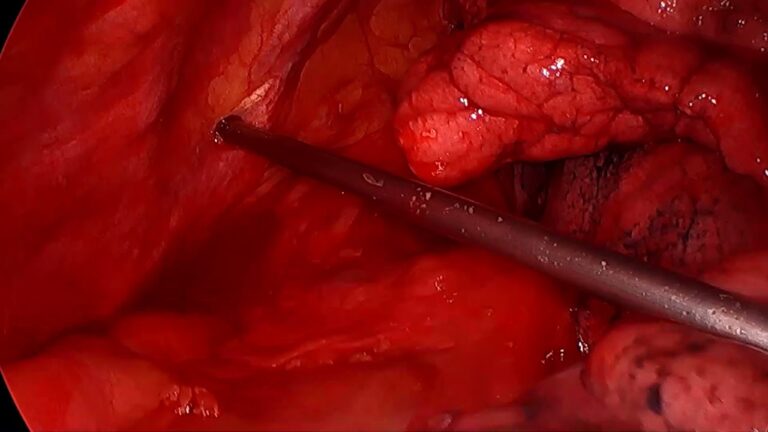 Derrame Pleural Neoplásico: Causas, Diagnóstico e Tratamento