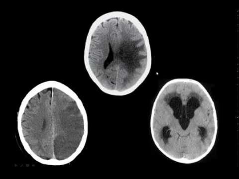 Entendendo o Edema Cerebral Vasogênico: Causas e Tratamentos