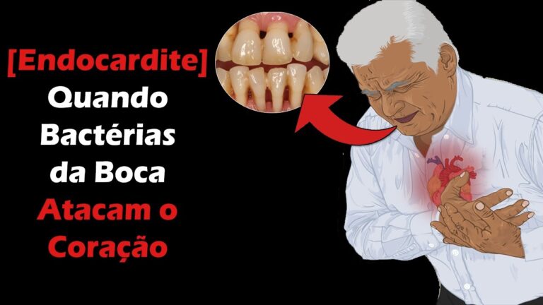 Como Contrair Endocardite Bacteriana: Causas e Prevenção