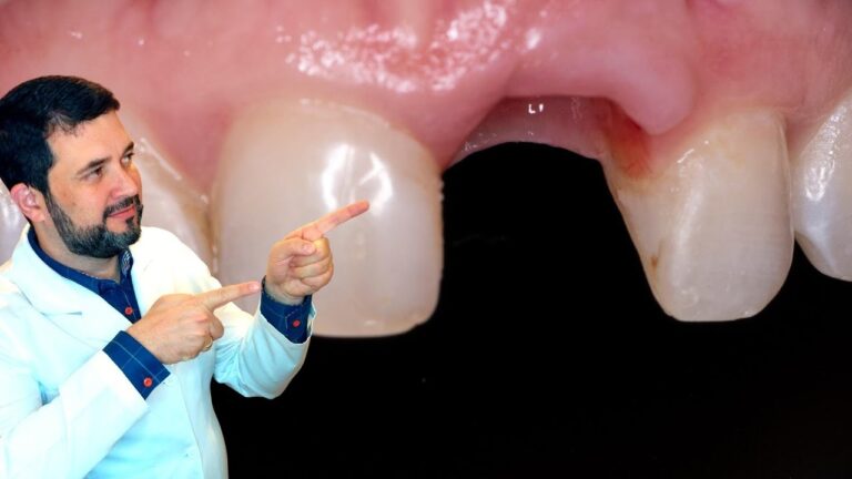 Cuidados Essenciais Após Dente Extraído