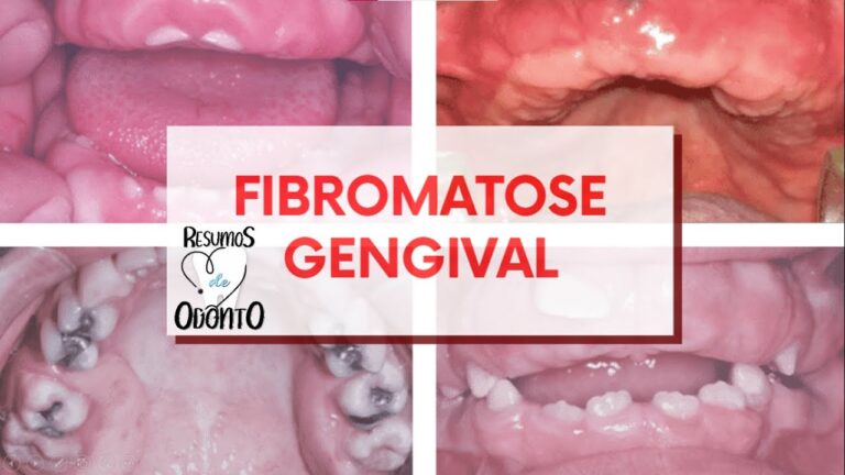 Fibromatose Oral: Diagnóstico e Tratamento Eficaz