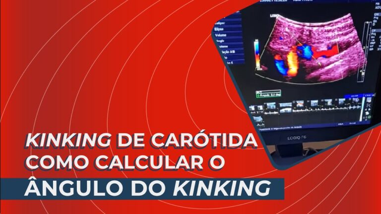 Kinking Carotida: Causas e Tratamentos Eficazes