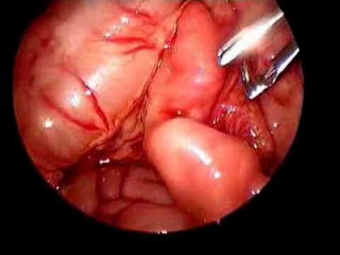 Cirurgia de Kasai: Solução para Atresia Biliar em Crianças
