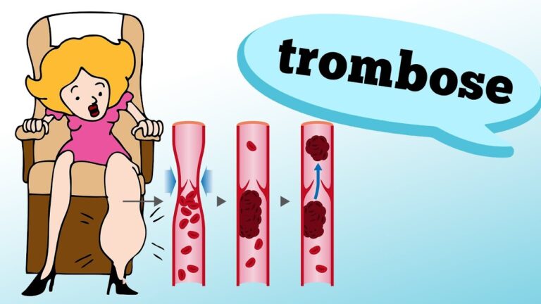 Trombose e Febre: Entendendo a Relação entre as Duas Condições