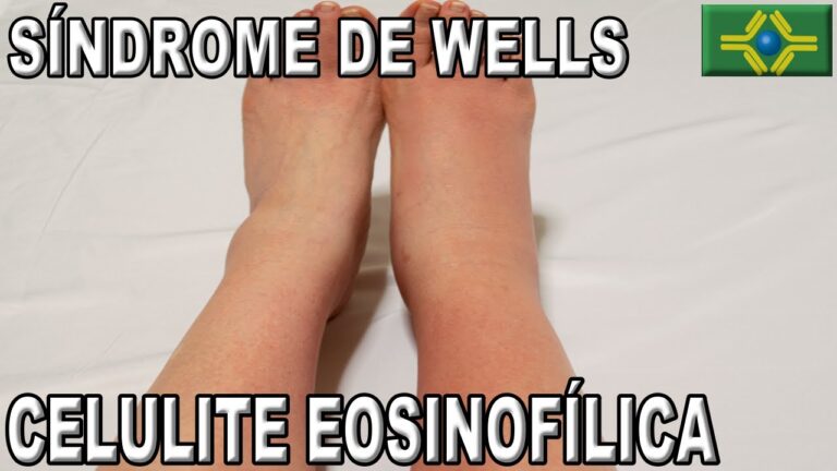 Entendendo o S&iacute;ndrome de Wells: Diagn&oacute;stico e Tratamento