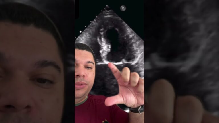 Seios de Valsalva: Estrutura e Função na Circulação Cardiovascular