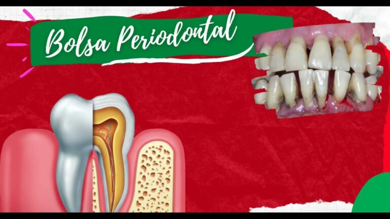 Import&acirc;ncia das Fotos de Bolsa Periodontal na Avalia&ccedil;&atilde;o Odontol&oacute;gica