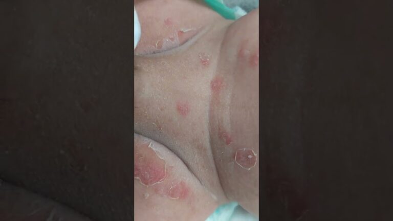 Impetigo Neonatal: Causas, Sintomas e Tratamentos