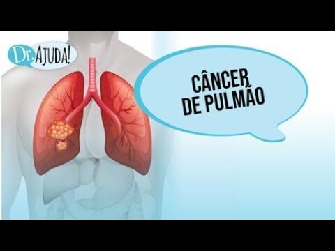 CID e Neoplasia Pulmonar: Entendendo a Classifica&ccedil;&atilde;o e Impactos