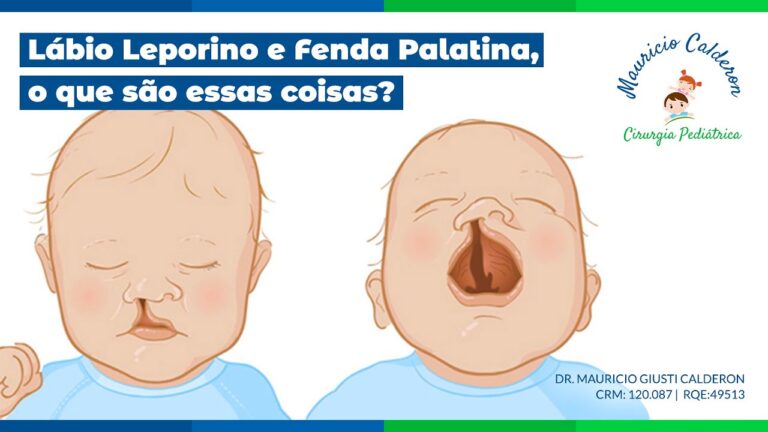 Cirurgia para Labio Leporino: Abordagens e Resultados