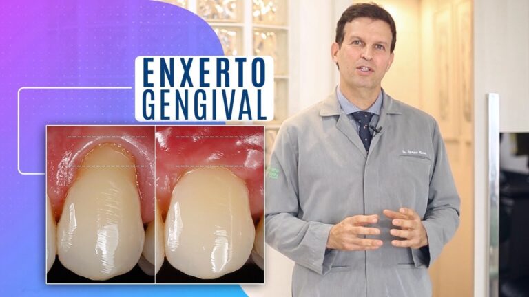 Guia Completo de Fotos de Enxerto de Gengiva