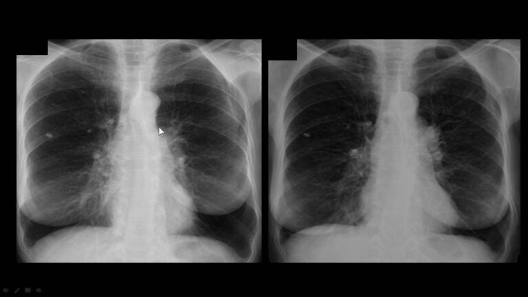 Significado de Hilos Pulmonares Proeminentes