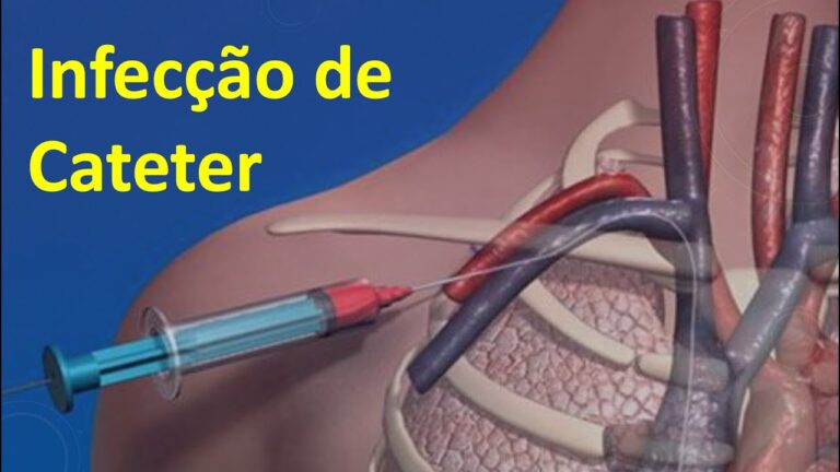 Antibióticos Eficazes para Infecções de Cateter