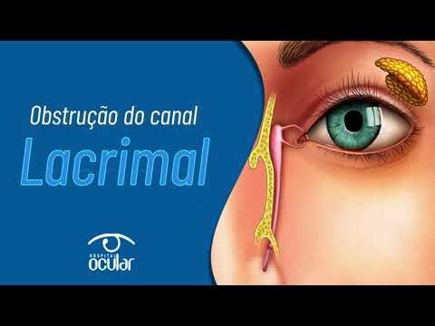 Entendendo a Obstrução do Canal Lacrimal: Causas e Tratamentos