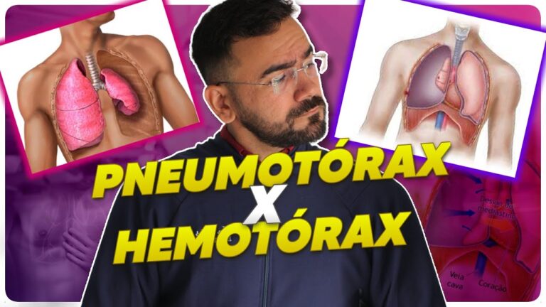 Entendendo o Hemotórax: Causas, Sintomas e Tratamento