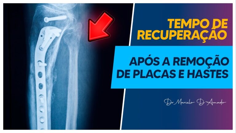 Recuperação Eficiente em Osteossíntese
