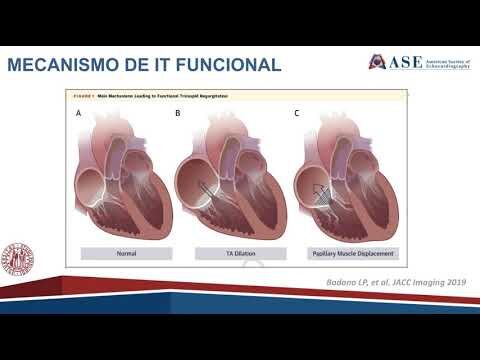 Regurgitação Tricúspide: Causas, Sintomas e Tratamentos Eficazes