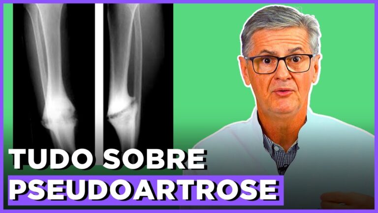 Cura da Pseudoartrose: Mitos e Verdades