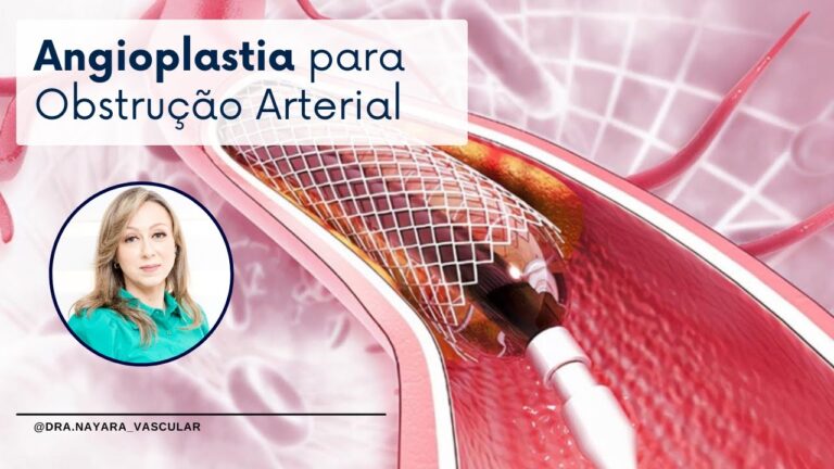 Recuperação Eficiente da Angioplastia na Perna
