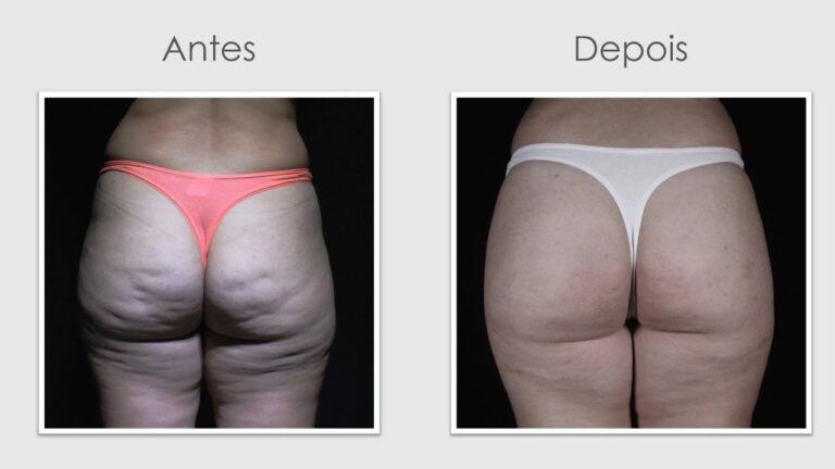 Transformações do Tratamento de Celulite: Resultados Antes e Depois ...