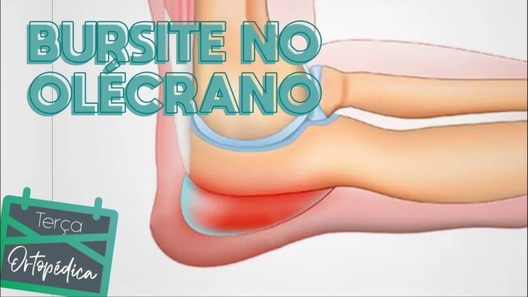 Entendendo a Bursite Olecrano: Causas e Tratamentos