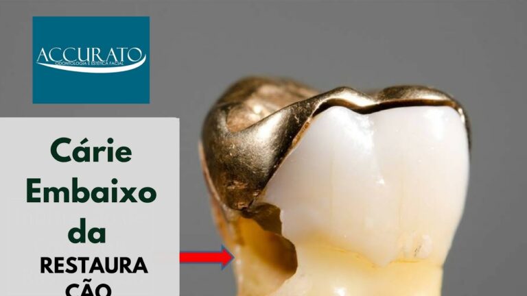 Infiltra&ccedil;&atilde;o no Dente: Causas e Tratamentos Eficazes