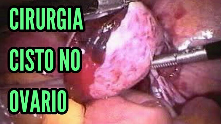 Retirada de Cisto Ovariano: Nome da Cirurgia e Procedimentos