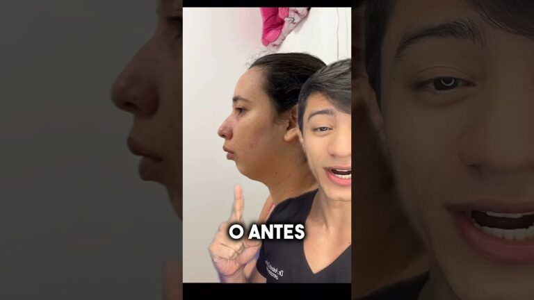 Queixo Pra Dentro: Causas e Soluções Eficazes